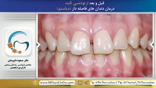 قبل و بعد ارتودنسی | دکتر مسعود داوودیان