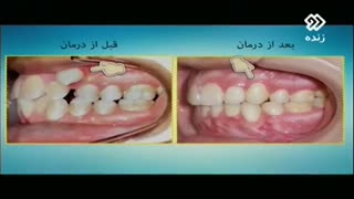 کشیدن دندان در ارتودنسی (قسمت دوم)| دکتر مسعود داوودیان
