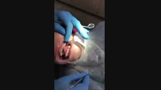 براکت گذاری