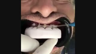 زیبایی دندان ها در سریع ترین زمان با روکش موقت