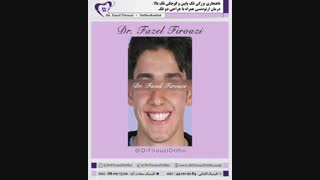 ناهنجاری فک و ارتودنسی | دکتر فاضل فیروزی زاویه سازی صورت
