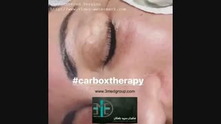 کربوکسی تراپی رفع افتادگی پلک