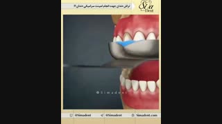 لمینیت سرامیکی | دندانپزشکی سیمادنت