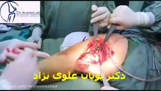 جراحی استئوتومی فمور