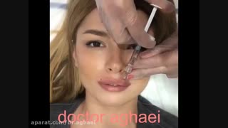 تزریق ژل لب ترمیم لبخند لثه‌ای