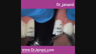 آماده سازی دندان برای لمینت