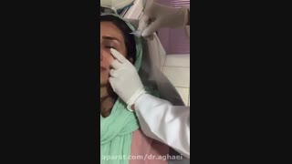 کربوکسی تراپی بلیچینگ دندان