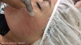 میکرونیدلینگ تزریق بوتاکس