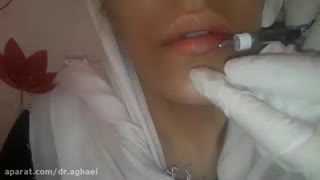 تزریق ژل لب پیلینگ