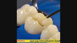 نحوه ترمیم دندان با کامپوزیت
