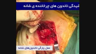 عمل پارگی تاندون های شانه
