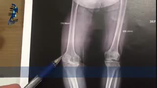 آرتروز زانو