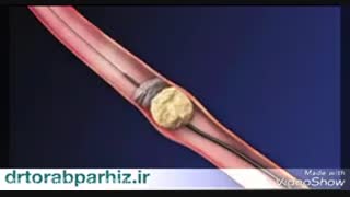 خارج کردن سنگ از لوله حالب