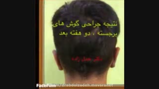 جراحی گوش برجسته