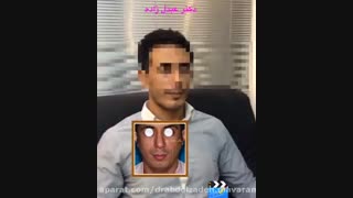 پروتز چانه ماموپلاستی