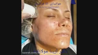 جوانسازی با rf فرکشنال لیفت صورت