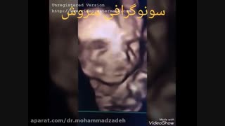 سونوگرافی 4 بعدی