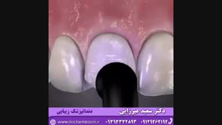 کامپوزیت دندان