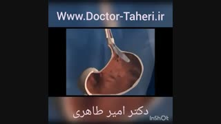 بالن گذاری داخل معده