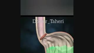 رفلکس معده و آسیب مری