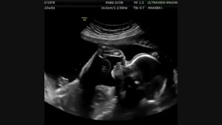 لمس نوک بینی جنین توسط انگشتان پا در سونوگرافی