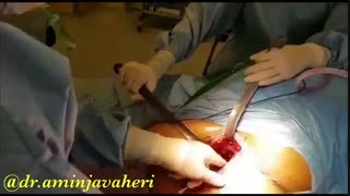 عمل جراحی تعویض کامل مفصل لگن توسط دکتر امین جواهری