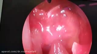 نشت مایع مغزی نخاعی از بینی پارت 1