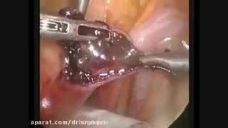 جراحی لاپاراسکوپی