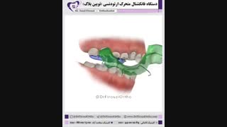 دستگاه فانکشنال ارتونسی | دکتر فاضل فیروزی دندان مصنوعی