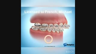 کش های بین فکی در ارتودنسی