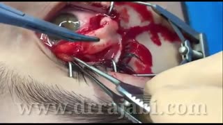 جراحی تومور مادرزادی لیپودرمویید