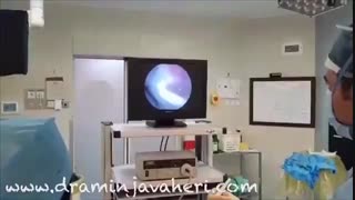 بازسازی رباط صلیبی قدامی به کمک اتوگرفت (پارت4)