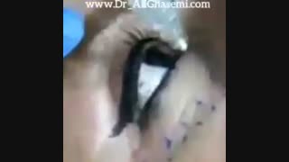 تزریق ژل زیر چشم