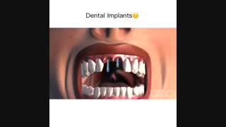 انیمیشن ایمپلنت دندان