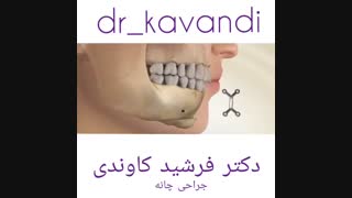 جلو آمدن چانه پر کردن دندان