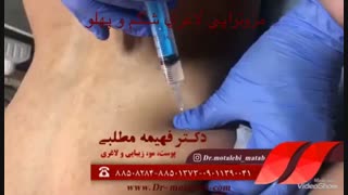 مزوتراپی لاغری کاشت ریش