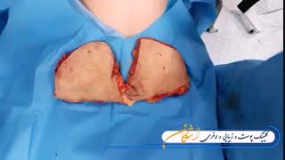 جراحی زیبایی شکم توسط متخصصین کلینیک اشکان