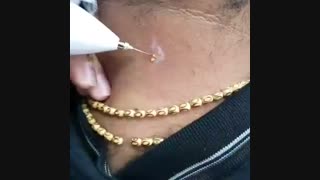 آموزش در آوردن خال بزرگ گوشتی با لیزر بیوتی پن