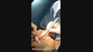 عمل جراحی تعویض مفصل زانو