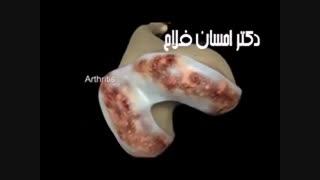 پروتز مصنوعی زانو