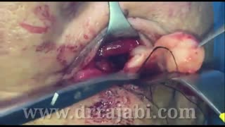 تومور بسیار وسیع و نادر عصب اینفرااربیتال