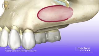 سینوس لیفت چیست؟