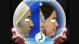 نمونه جراحی بینی