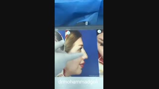 جراحی بینی در اتاق عمل