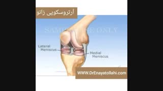 آرتروسکوپی زانو