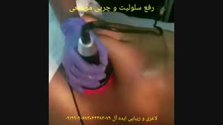 لاغری موضعی سریع با کویتیشن