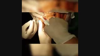 کاشت ابرو - دکتر ابدالی - 22807060
