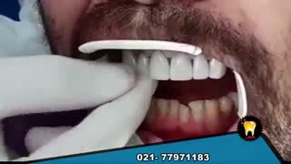 لمینت کردن دندانها رو ببینید
