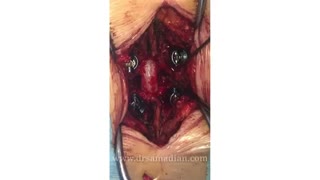 روش ترانس فاست جهت عمل جراحی دیسک توراسیک استخوانی