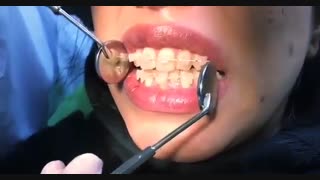 فیلم انتخاب براکت سرامیکی و وایر همرنگ توسط بیمار